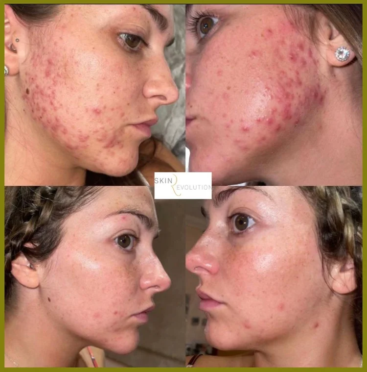 Acne reversal client story