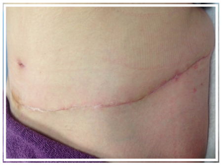 Scar recovery treatment story