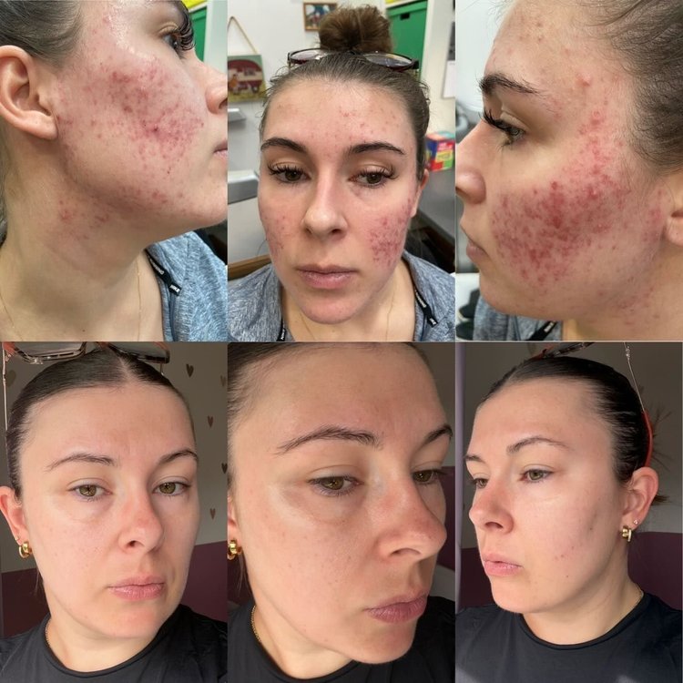 Acne client story