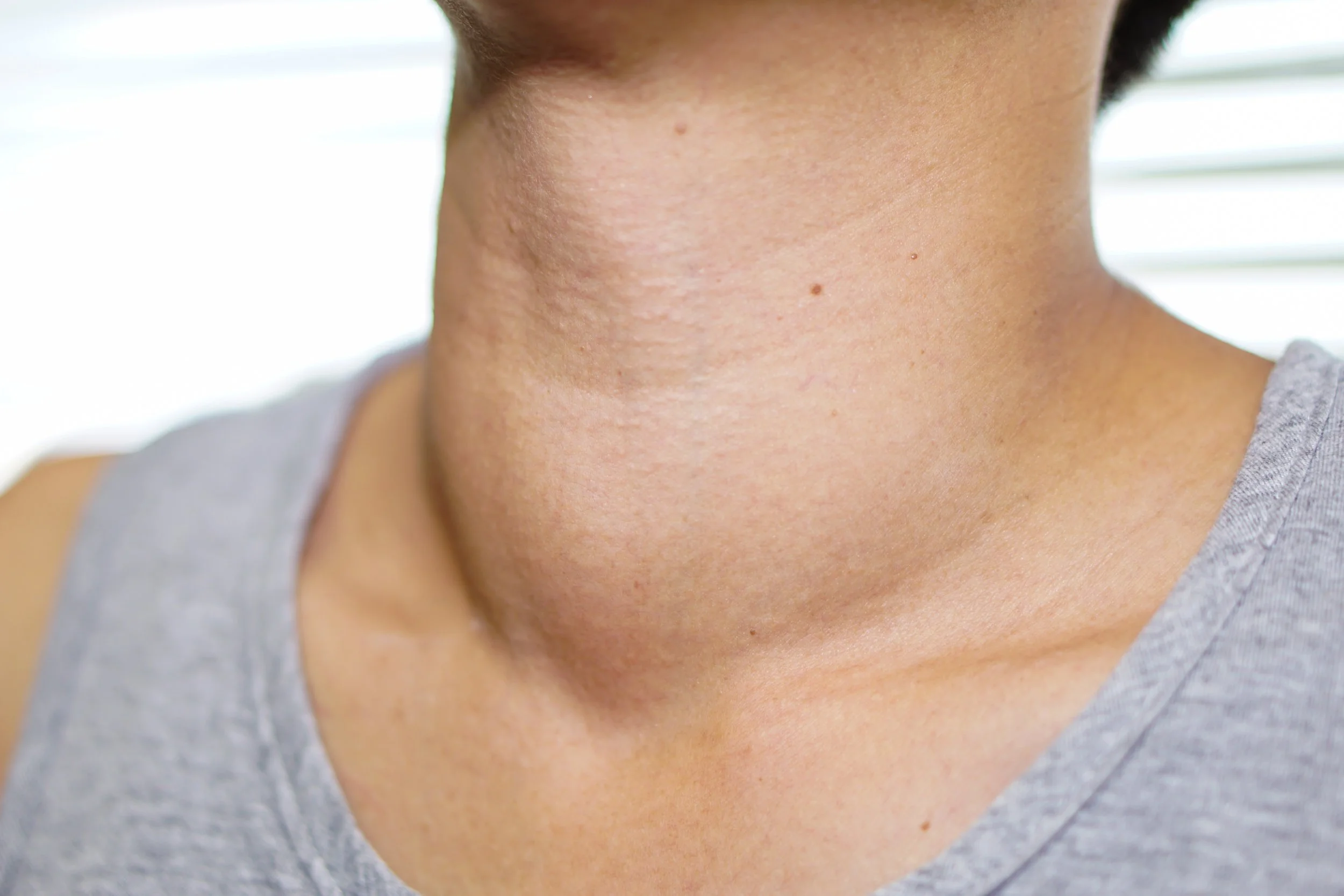 Thyroid Assessment and Surgery