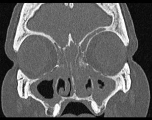Complex Sinus Surgery and Image Guidance