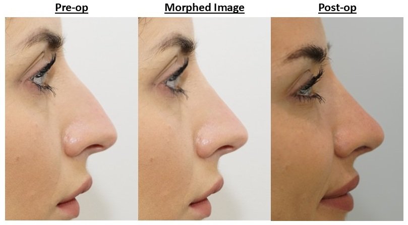 Should You Rely on Morphed Images Before Rhinoplasty?
