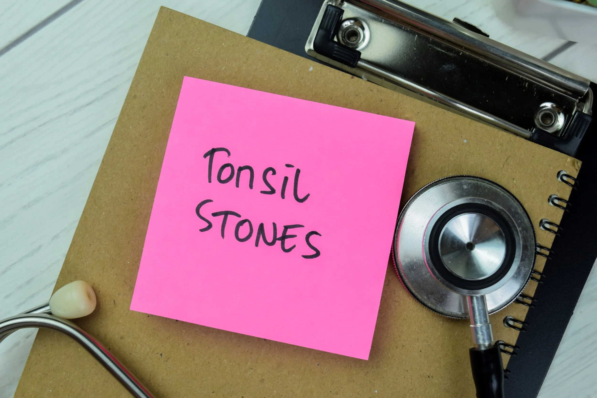 Tonsil Stones (Tonsilloliths): Causes, Symptoms, and Treatment