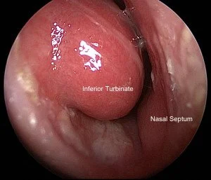 Turbinoplasty: A Modern Solution for Nasal Blockage