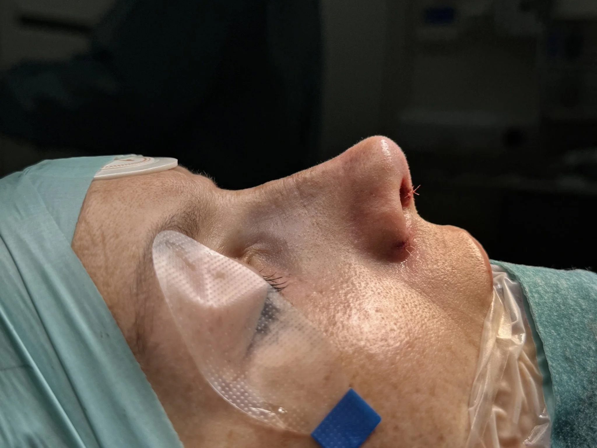 Dorsal Preservation Rhinoplasty: A Natural Approach to Nose Reshaping
