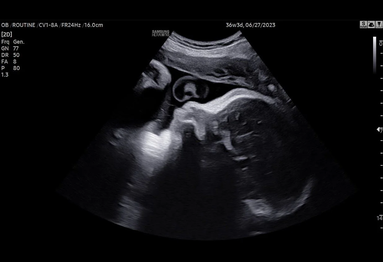 bundles-ultrasound-boutique-3d-4d-ultrasound-photography