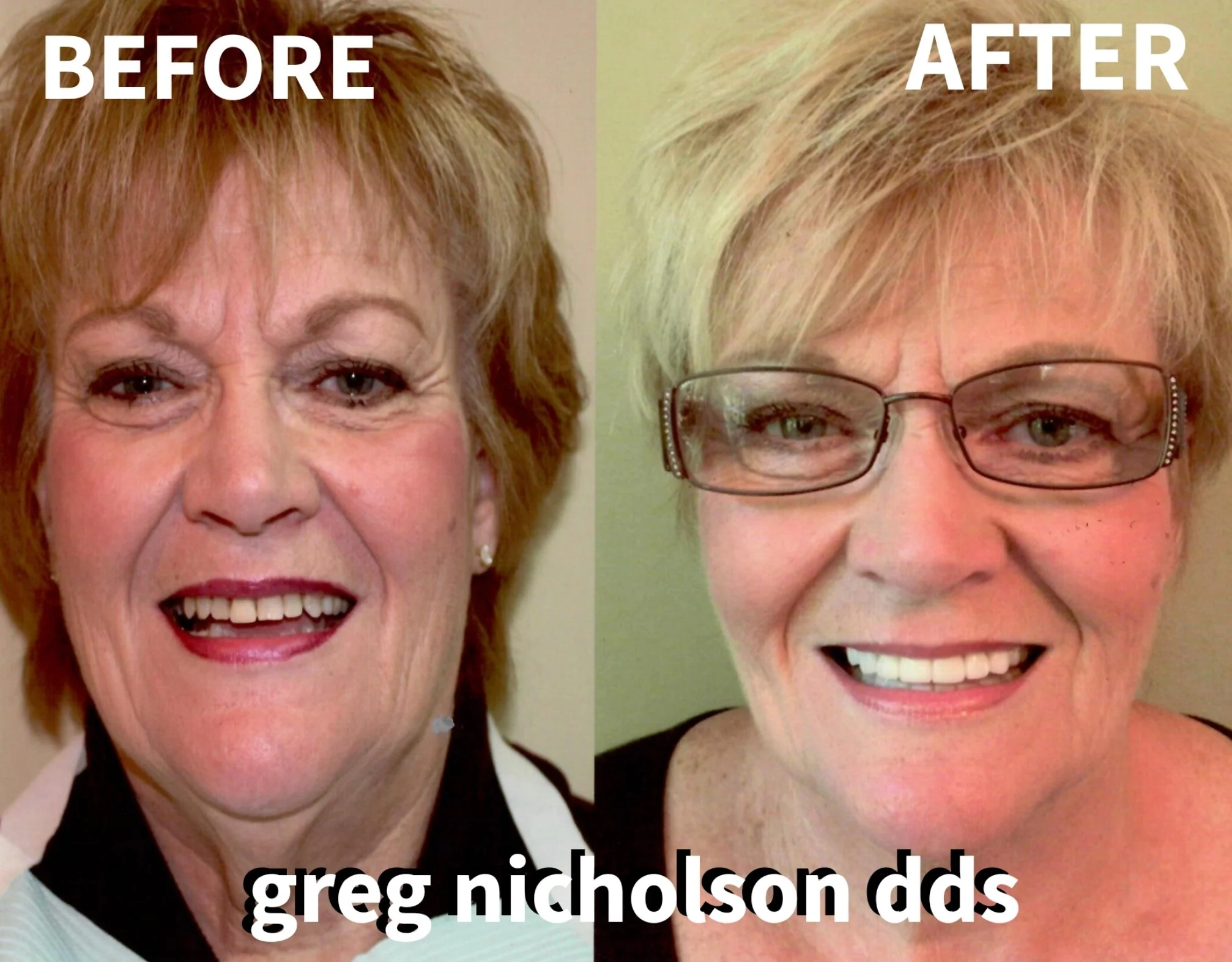 Woman before and after natural looking dental crowns by Dr. Greg Nicholson in Murfreesboro