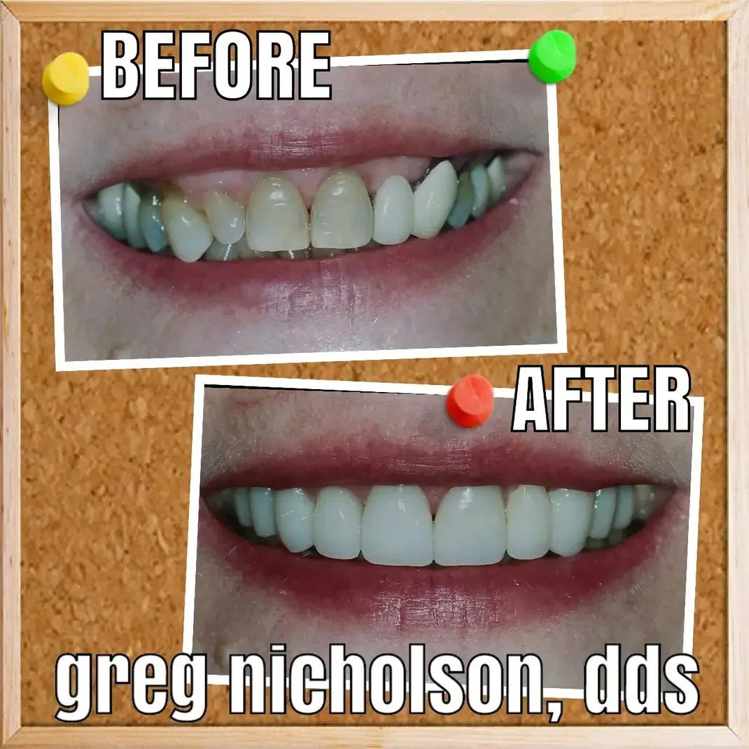 Professional dental crowns in murfreesboro