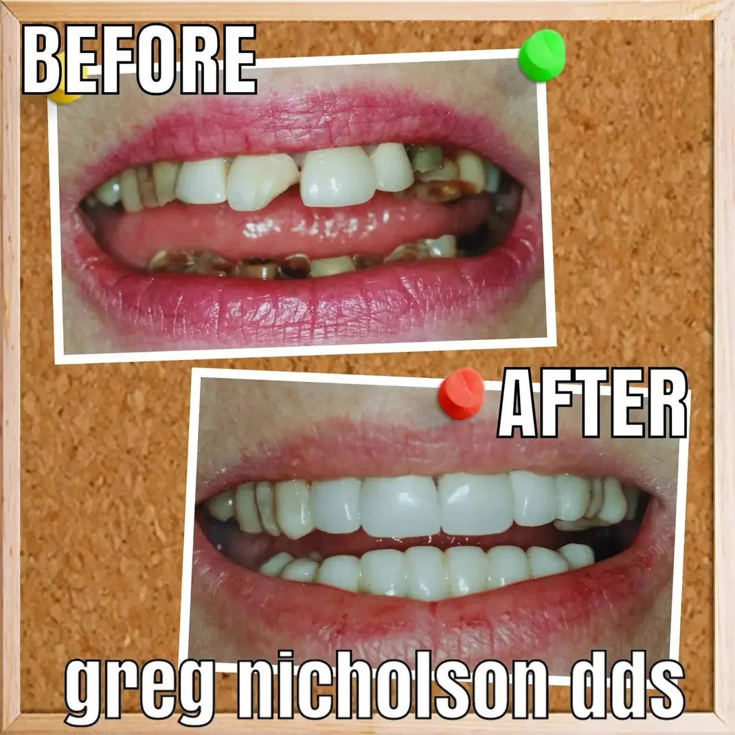 Natural looking dental crowns before and after in Murfreesboro