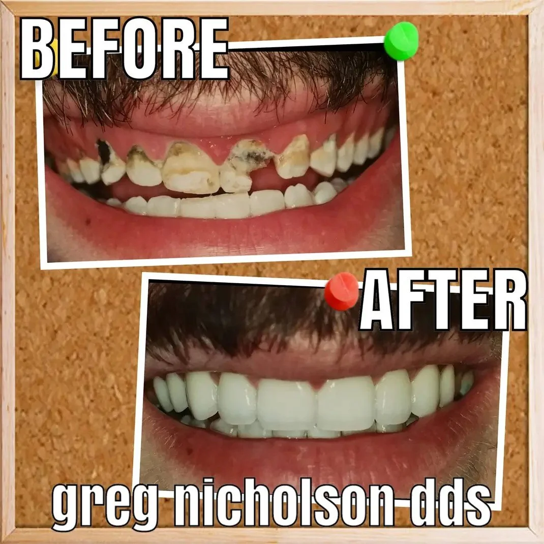 Natural looking dental crowns by Dr. Greg Nicholson in Murfreesboro