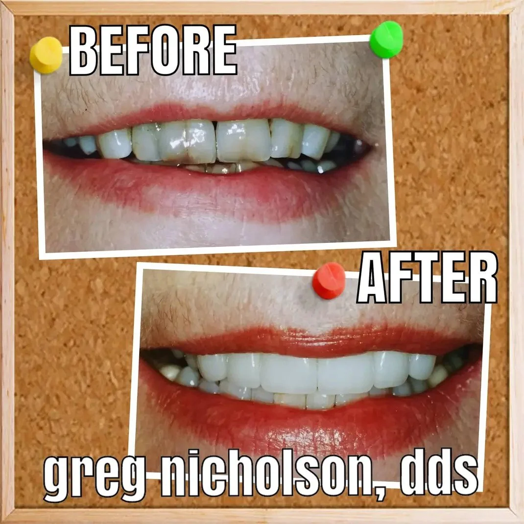 Before and after dental crowns results in Murfreesboro