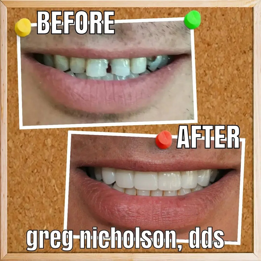 Affordable dental crowns before and after results in Murfreesboro