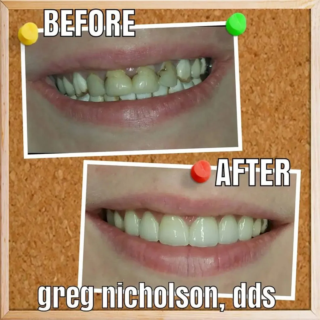 Dental crowns results in Murfreesboro