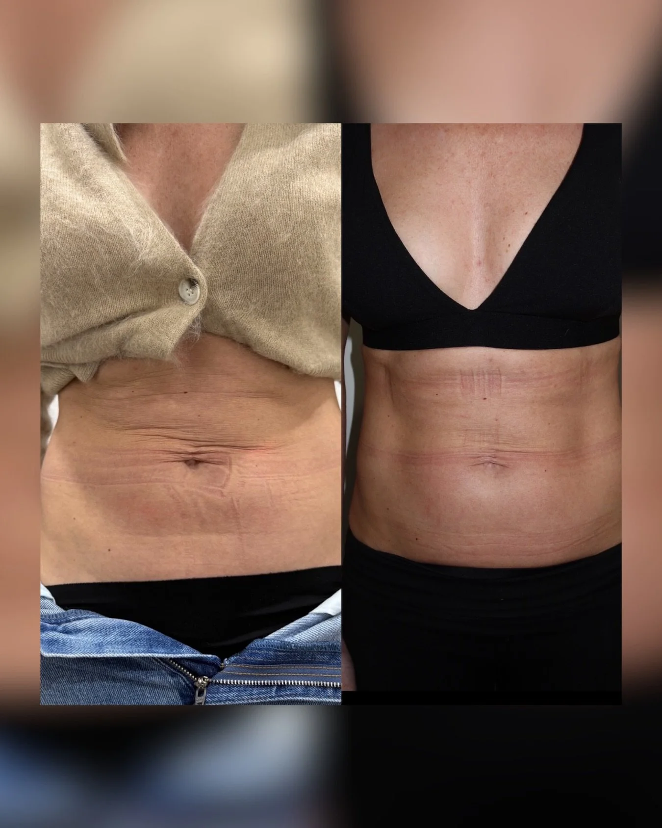 Targeting the stomach, Morpheus 8 remodels, tightens, and smooths the skin from the inside out. 

Say goodbye to loose, uneven texture and hello to firmer, more sculpted results.

Book your consultation and see what your skin could do next 👀

#skins