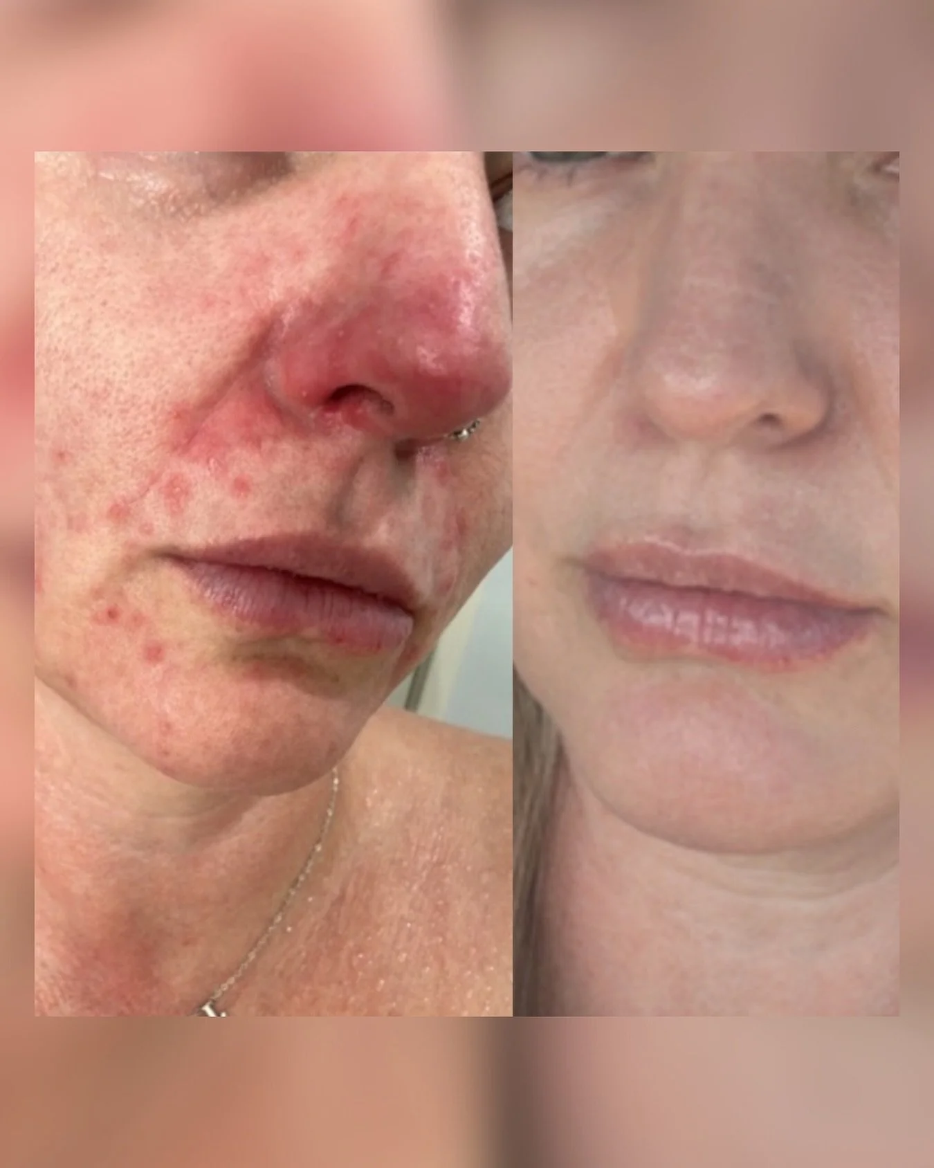 Before &rarr; After. No filter, no AI, just results 🫠

Our pigmentation solutions actually work. Grab UPTO 40% off during our sale and see for yourself.

https://www.skinstudiobylaura.com/shop/pigmentpromos

#skinstudiobylaura #goldcoast #kirra #coo