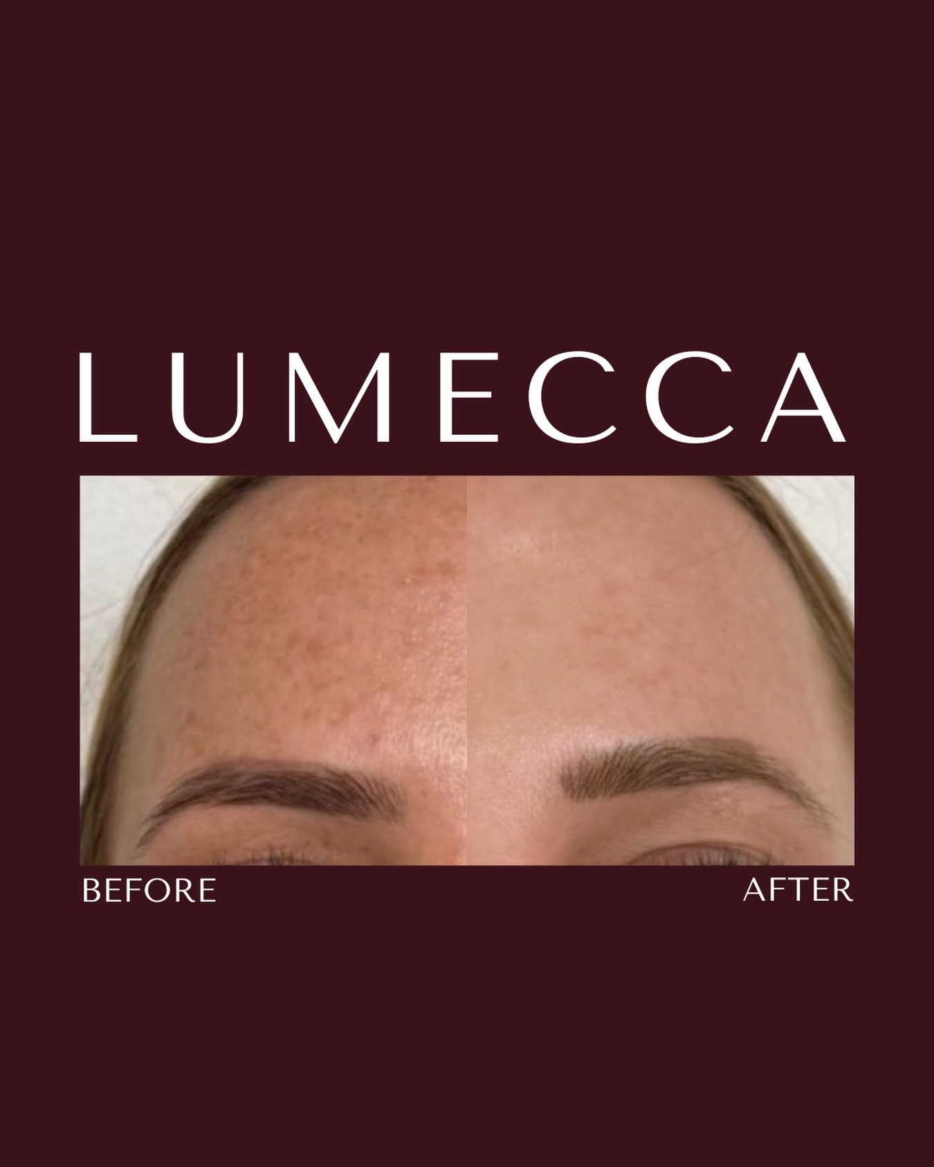 Stubborn sun spots? Uneven tone? Lumecca&rsquo;s got you. 

Smoother, brighter, and actually real results.

Your skin called. It wants this and it can now have it&hellip;40% OFF 🔥&hearts;️

https://www.skinstudiobylaura.com/shop/pigmentpromos

#skin