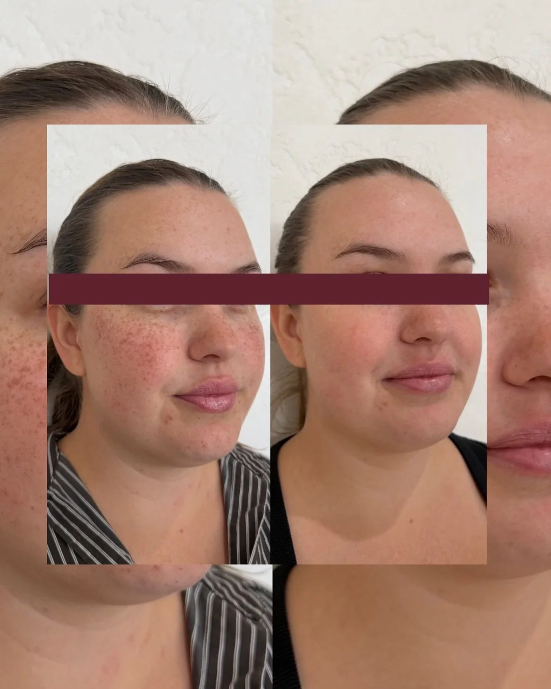 For all of our clients  who have spent the summer in the sun, this before &amp; after result speaks for itself. 

Tackle built-up pigmentation, uneven tone, and sun damage with treatments like Lumecca, Melano Stop, and TCA Peels. 

Real results start