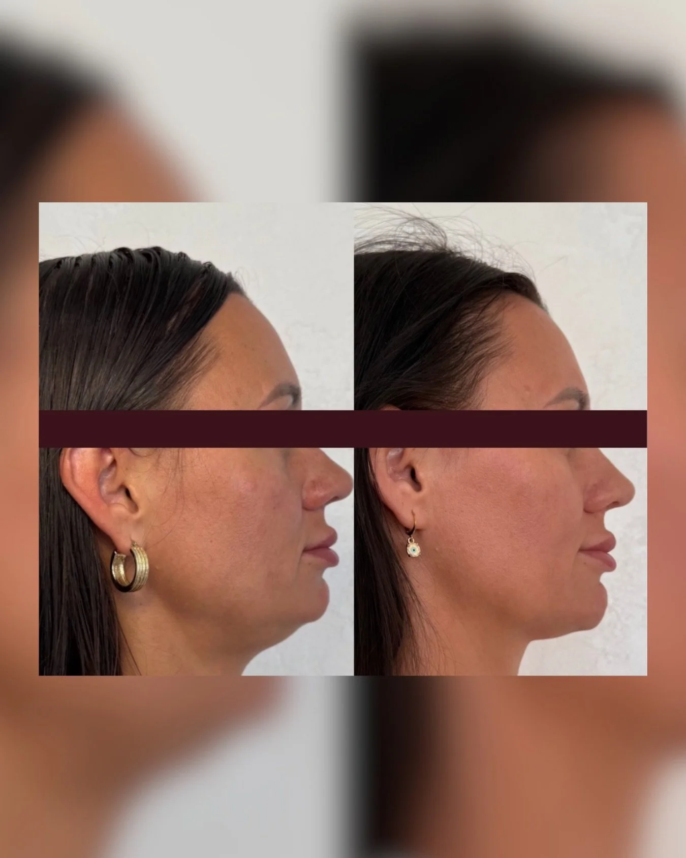 🍂 Autumn skin check!

Season changes can leave your skin dull, dry, and just&hellip; not showing up.
Before &rarr; After: proof that your skin can bounce back. 

Colder months = perfect time to reset and glow.

Not loving your skin lately? DM us &ld