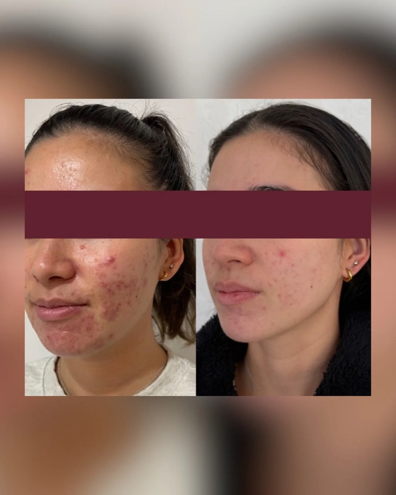 This is what happens when you stop guessing and start treating acne with intention. No quick fixes, no band aid solutions, just a structured, result driven approach that actually works with your skin, not against it.

From highly inflamed, reactive a