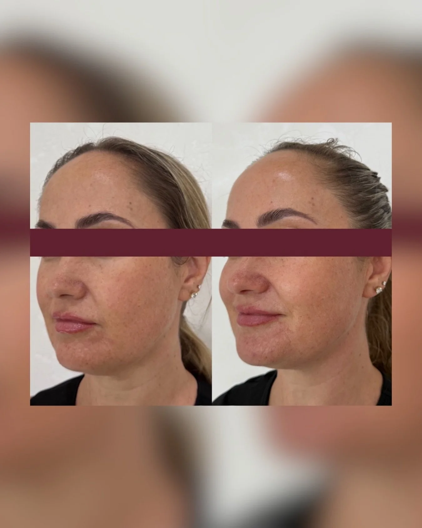 This is a clear example of what targeted collagen stimulation can achieve when we treat beyond the surface. Skin that has started to lose firmness, structure, and definition needs more than topical support.

It needs controlled injury, precision dept