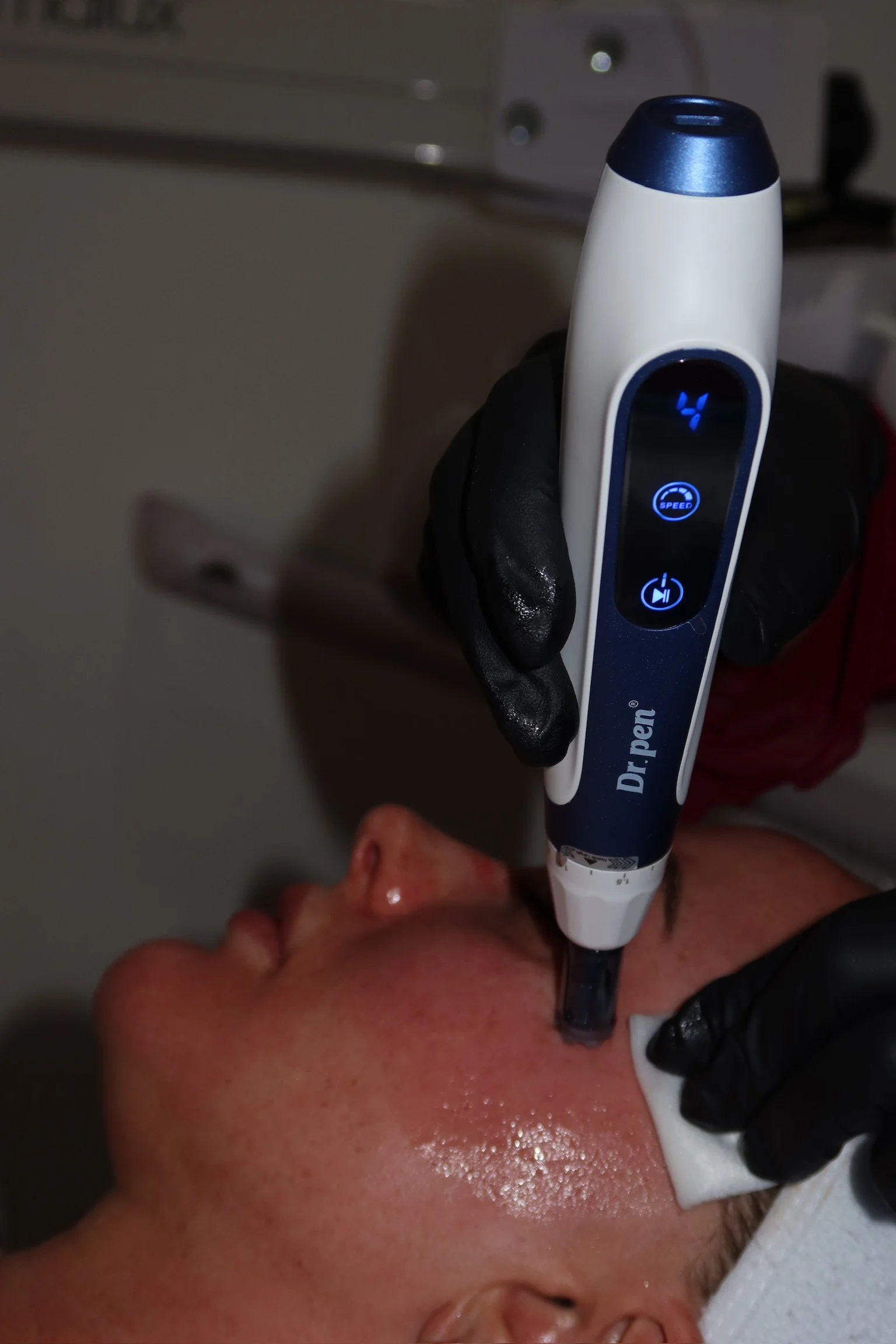 40% OFF SKIN NEEDLING FACE & NECK