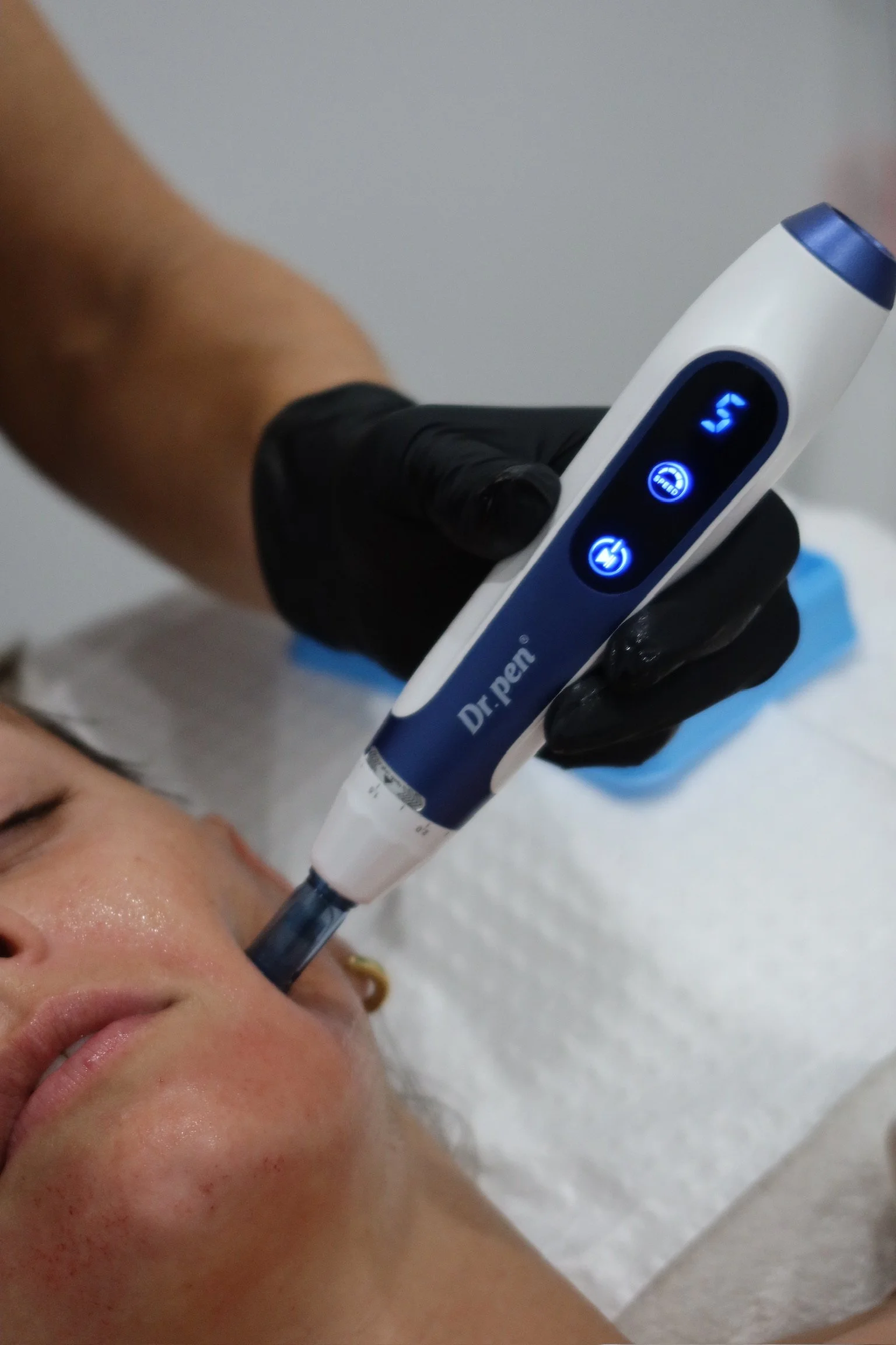 40% OFF SKIN NEEDLING - FACE NECK AND DEC
