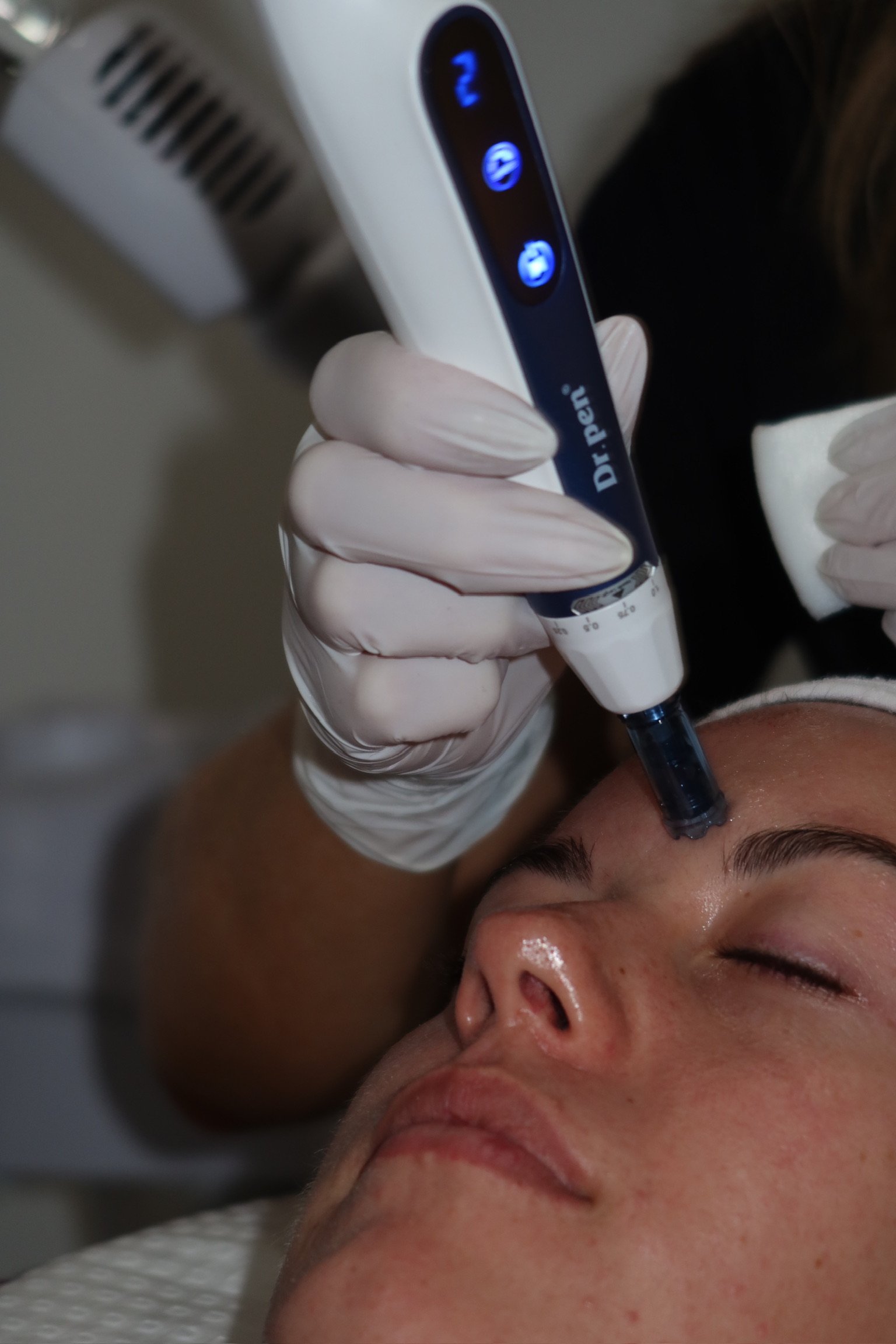 40% OFF SKIN NEEDLING - FACE