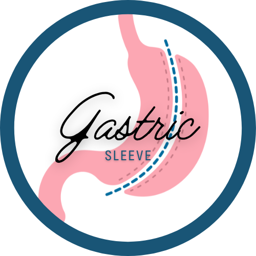 Illustration of a gastroesophageal sleeve, showing the stomach being surgically reduced, with the word "Gastric Sleeve" in the center.