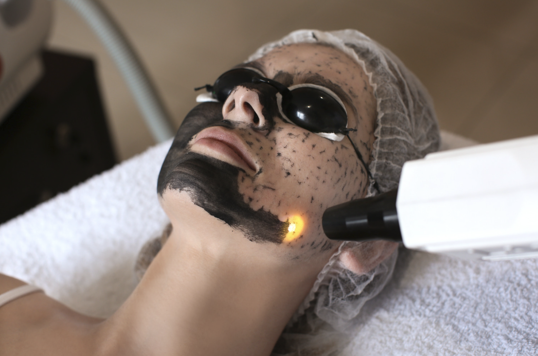 Carbon Laser Facial