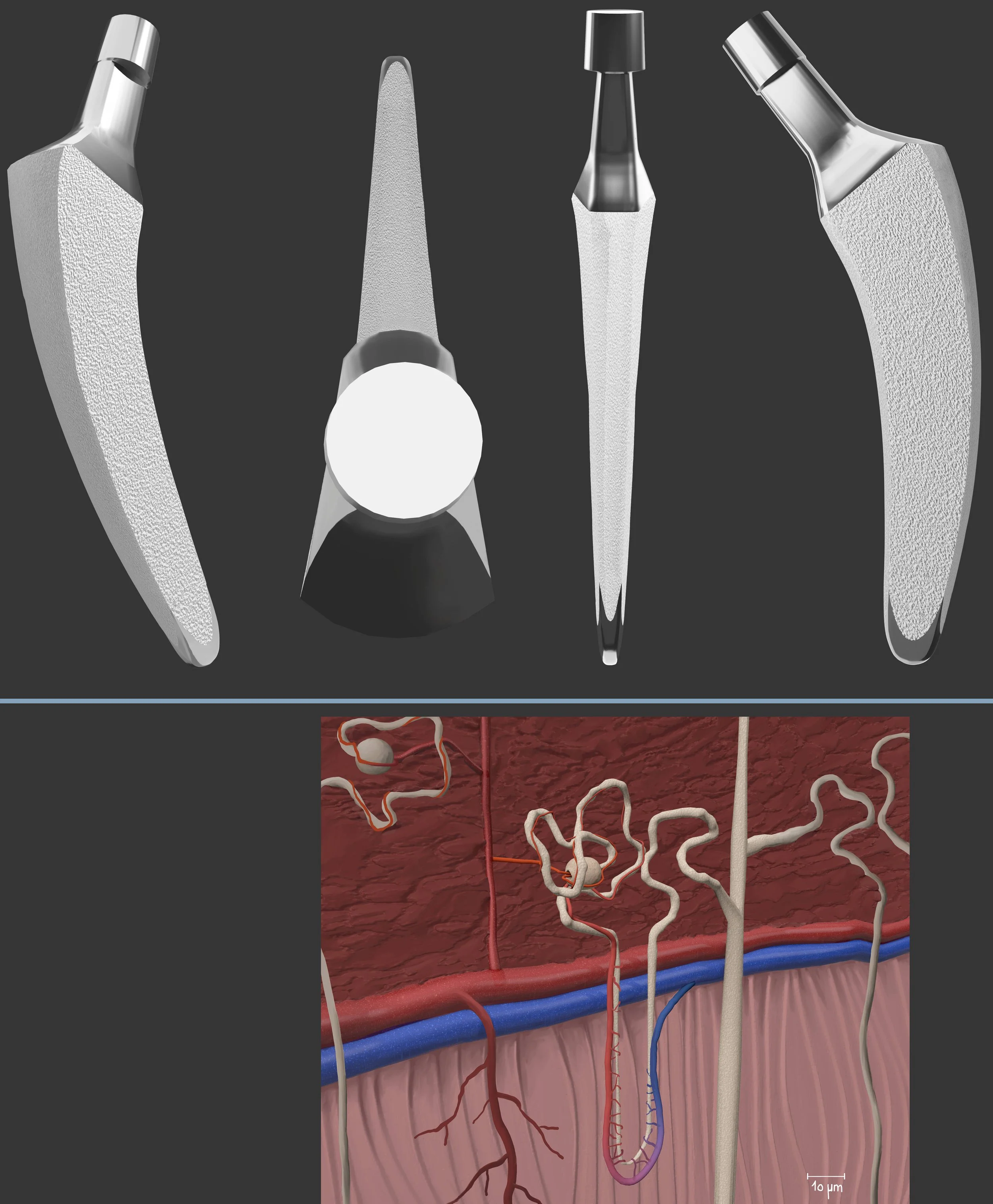 Hüftprothese: 3D Modelliert / Nephron: Verschiedene 3D Modelle modelliert und collagiert und durch 2D Zeichnung finalisiert