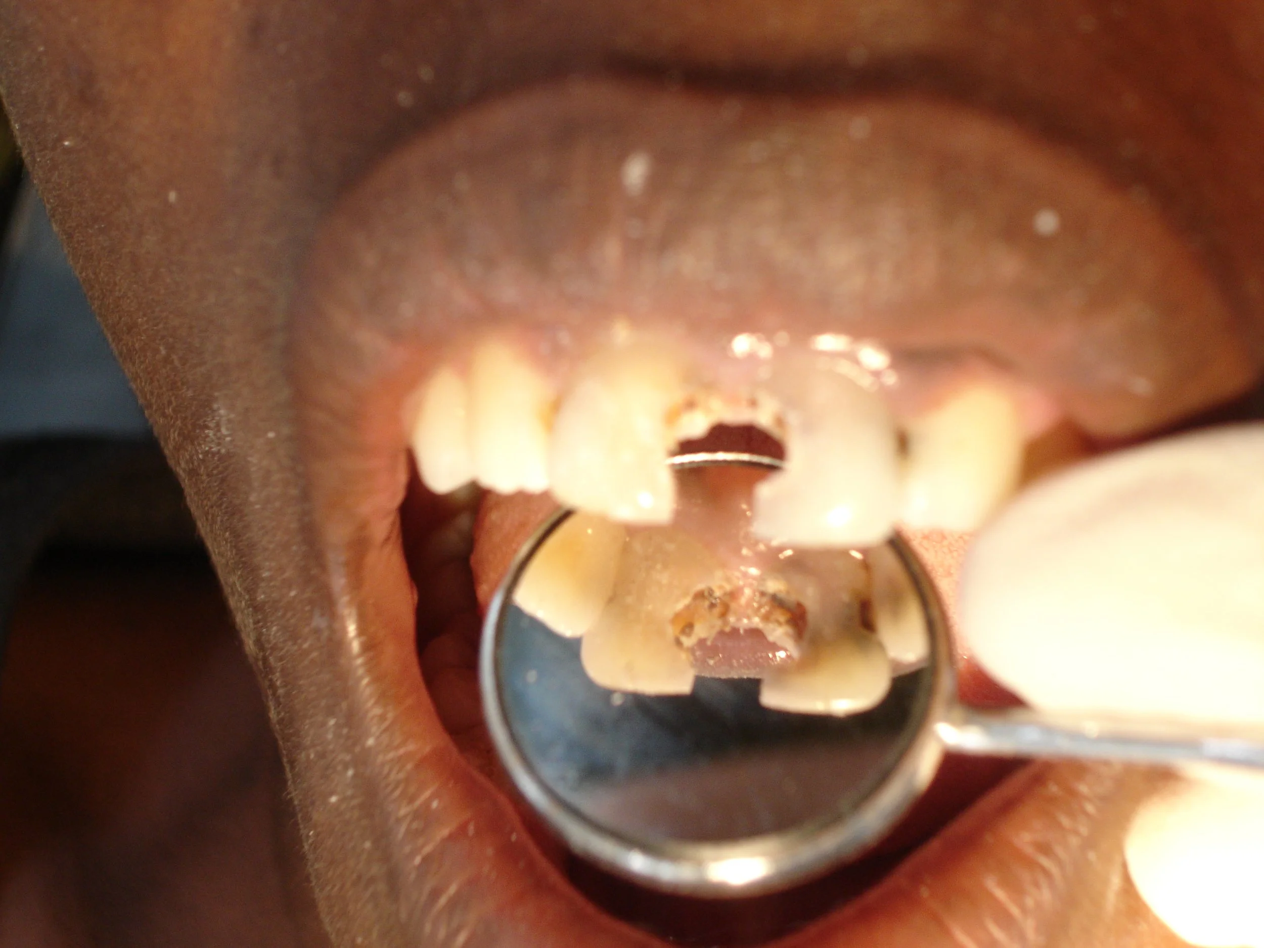 man-mouth-broken-teeth