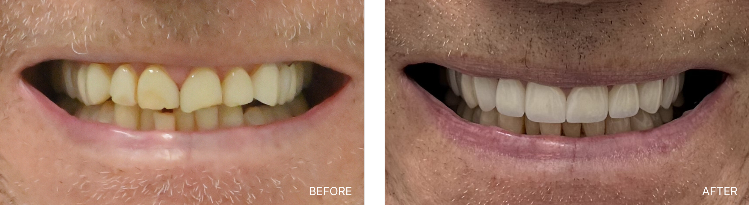 Comparison image showing a person's teeth before and after dental whitening treatment; the "before" side shows yellowed teeth, the "after" side shows whiter teeth.