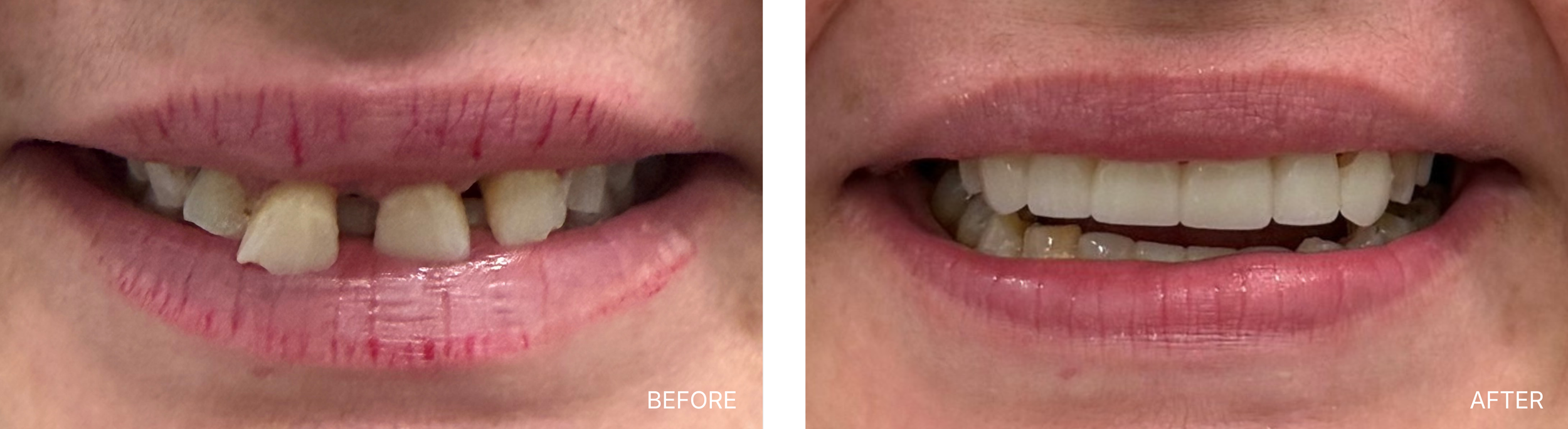 Comparison of a person's teeth and smile, showing stained, crooked teeth in the 'before' image and straight, white teeth in the 'after' image.