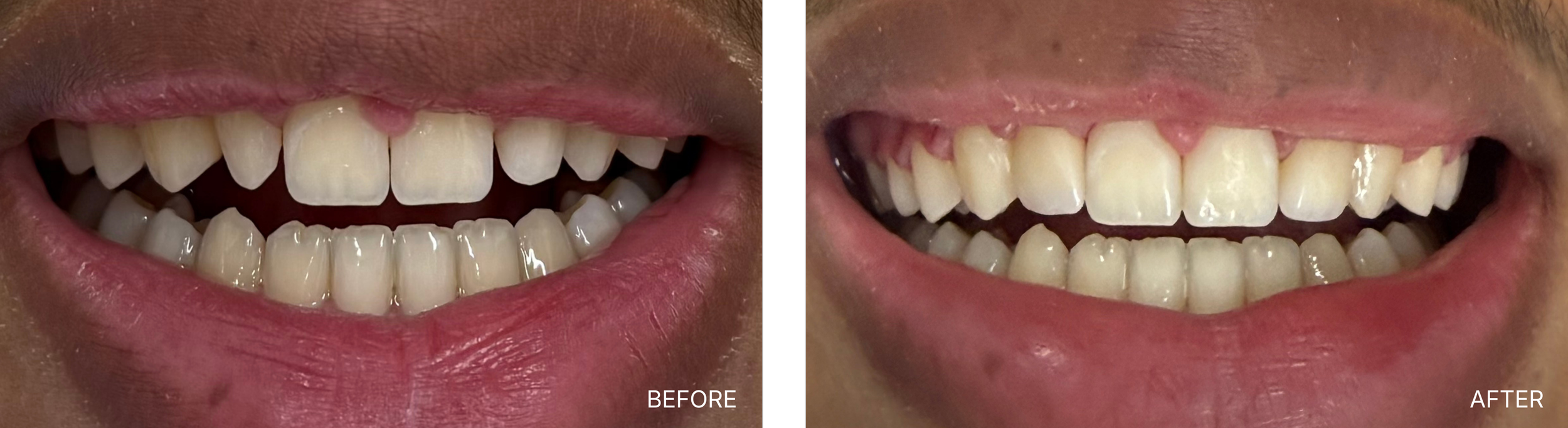 Close-up of a person's smile showing teeth before and after dental whitening, with the 'before' image on the left and the 'after' image on the right.