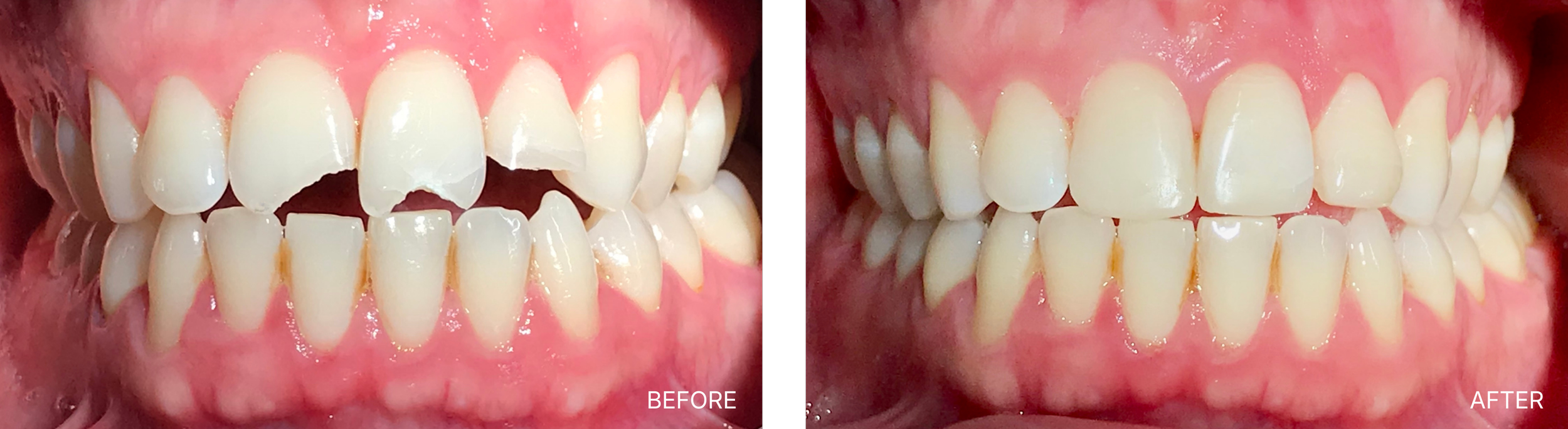 A side-by-side comparison of a person's teeth before and after dental treatment. The left side shows teeth that are chipped, misaligned, and have gaps. The right side shows teeth that are straight, even, and in good condition.