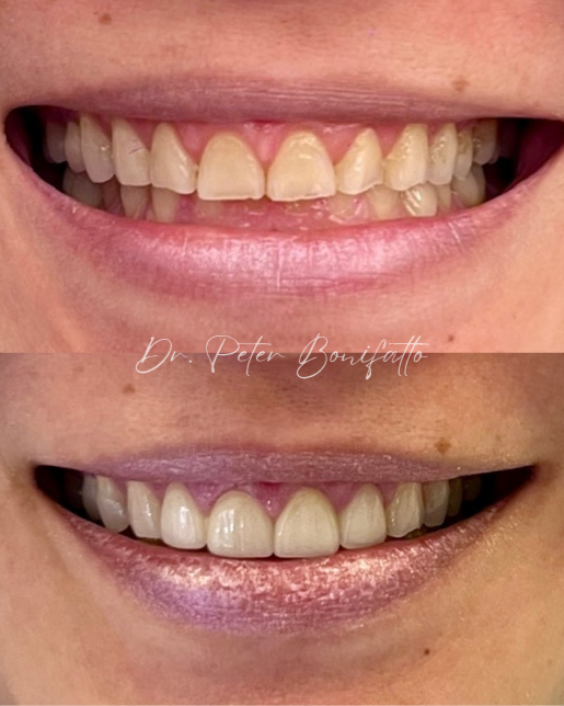 veneers in Las Vegas
