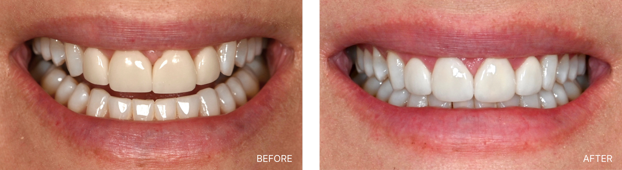 Before & Afters Smile Only.png