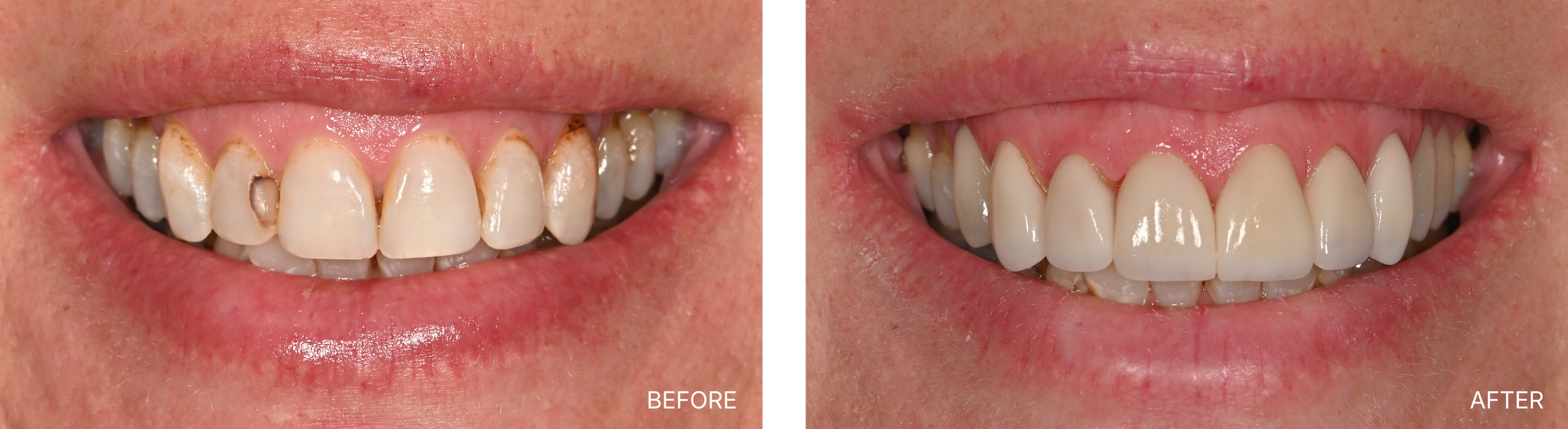 Close-up of a person's mouth showing a before-and-after comparison of dental treatment. The 'before' side shows discolored, decayed, and damaged teeth, while the 'after' side shows white, straightened teeth with improved appearance.