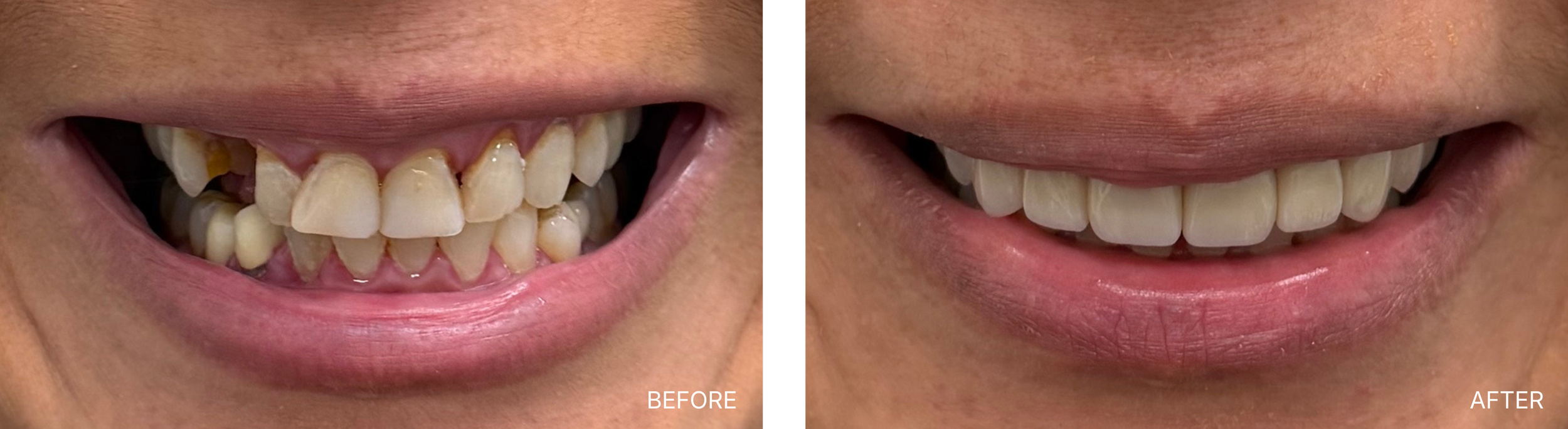 Comparison of teeth before and after dental treatment, showing significant whitening and alignment improvements.