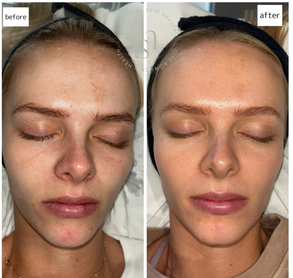 This is what consistency looks like ✨

Imke started her skincare journey with us in 2025, and the goal was never &ldquo;perfect skin&rdquo;  although we are getting pretty close 😉 , but rather to build healthier, stronger skin over time.

So often c