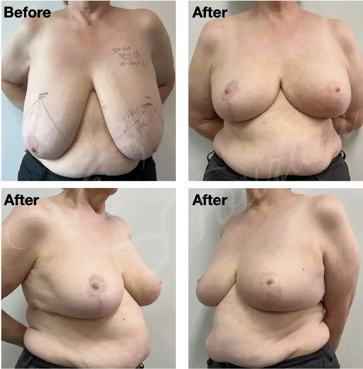 Case 103: 1 year post left breast lumpectomy + therapeutic mammoplasty + simultaneous right symmetrising breast reduction