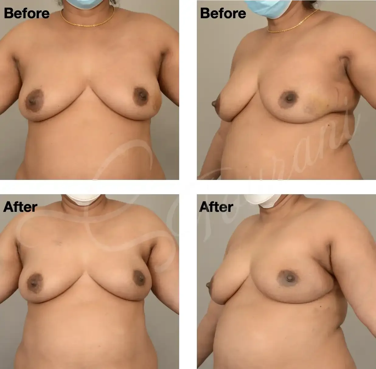 Case 108: 6 months post left breast lumpectomy for a large cancer + LICAP flap