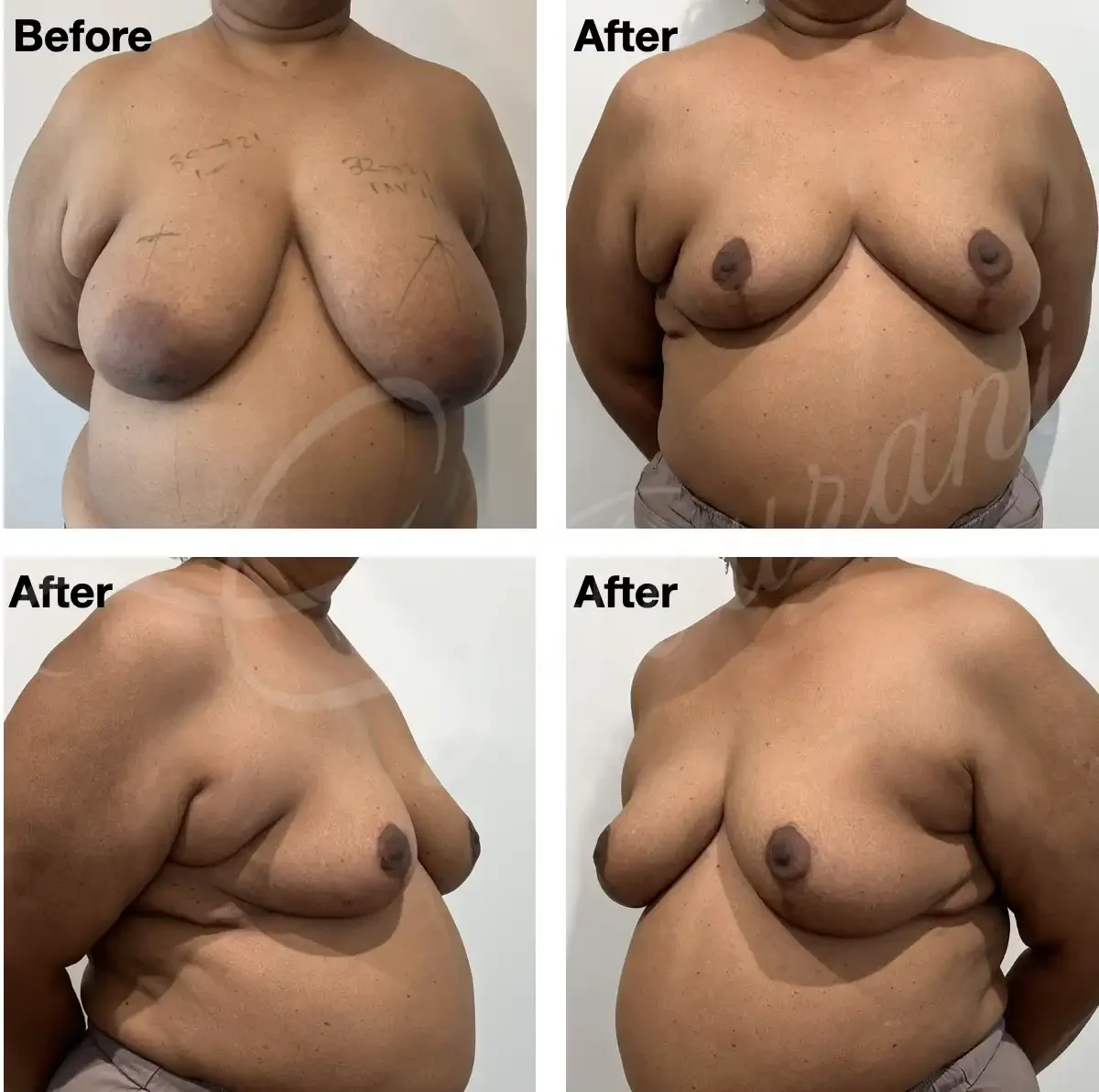 Case #208: One year post bilateral breast reduction. 