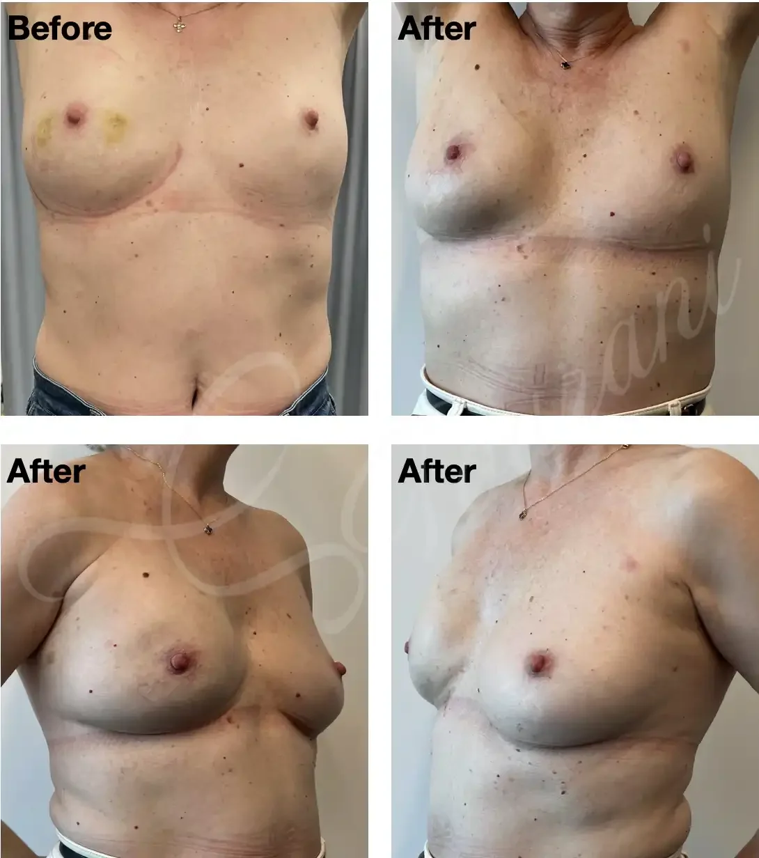 Case #307: One year post right nipple sparing mastectomy + immediate 1-stage implant reconstruction. 