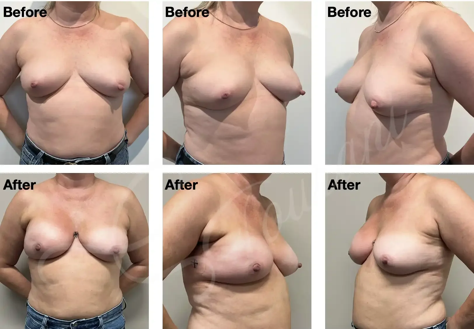 Case #310: Right nipple sparing mastectomy + immediate 1-stage implant reconstruction. Images are flowing radiotherapy. 