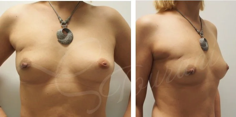 Breast cancer lumpectomy defect Oncoplastic breast cancer surgery