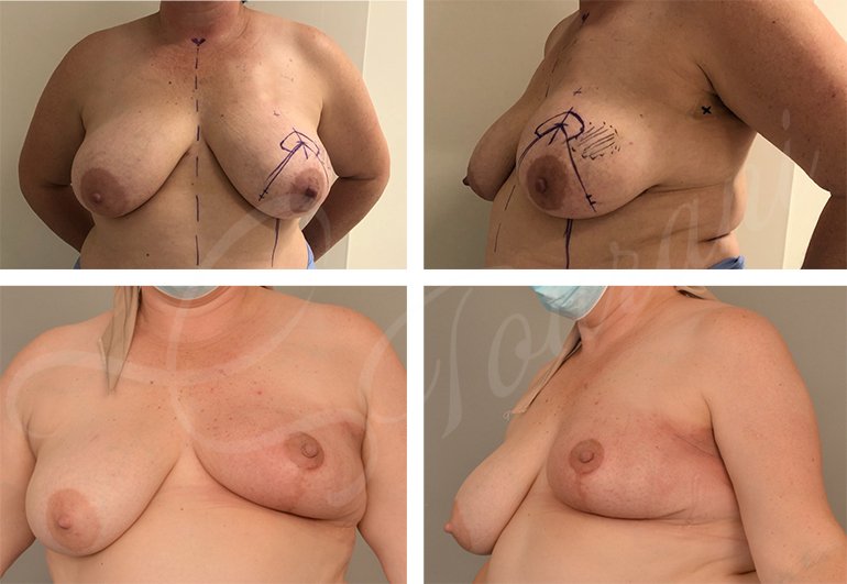 therapeutic mammoplasty for breast cancer, Oncoplastic surgery, breast reduction