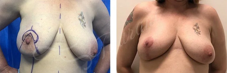 Breast lift, mastopexy, therapeutic mammoplasty, Oncoplastic breast cancer surgery.