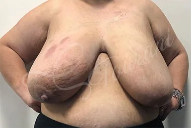 Breast lymphoedema, breast cancer, breast reduction, Oncoplastic breast cancer surgery