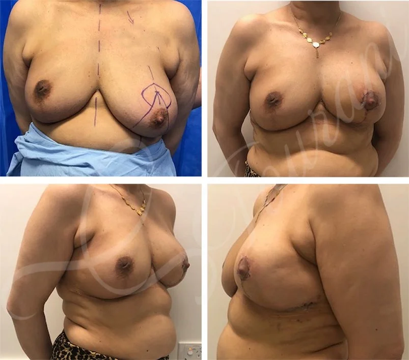 therapeutic mammoplasty, breast reduction, Oncoplastic breast cancer surgery, lumpectomy, symmetrising mammoplasty.